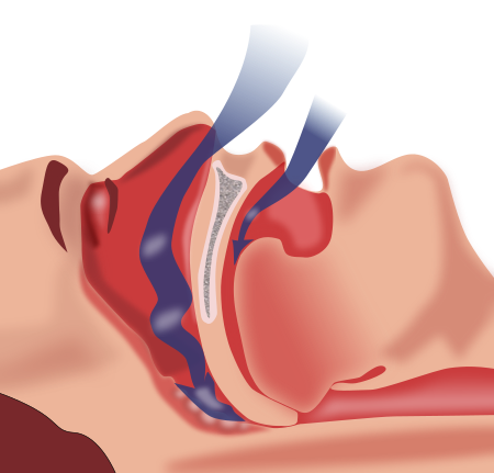 Obstruction Sleep Apnea